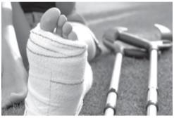 A fractured leg in a plaster cast.